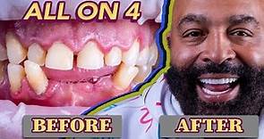 All on 4 Dental Implants Before & After Smile Transformations | My New Smile Dental