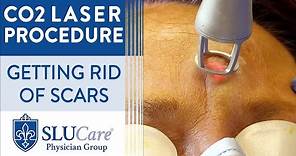 CO2 Laser Resurfacing Treatment For Getting Rid of Scars - Full Procedure