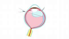 Retinal Detachment Treatment—Pars Plana Vitrectomy