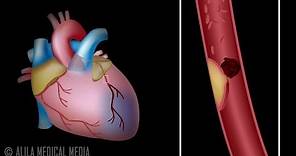 Myocardial Infarction and Coronary Angioplasty Treatment, Animation.