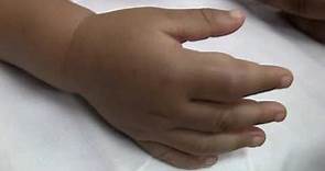 Hand-Foot Syndrome