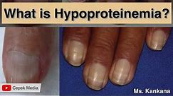 What is Hypoproteinemia