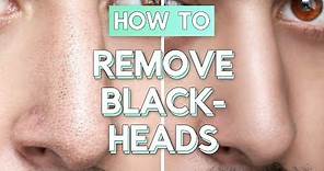 No Bullsh*t Blackhead Removal - How To Remove Blackheads From Face / Nose ✖ James Welsh