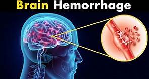 What Happens in Brain hemorrhage? | Symptoms, Causes and Treatment (3d animation)