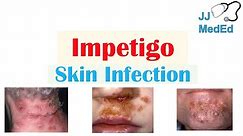 Introduction to Impetigo | Infection, Subtypes and Treatment