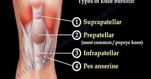 Knee Bursitis,prepatellar bursitis - Everything You Need To Know - Dr. Nabil Ebraheim