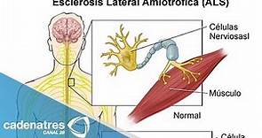Neurólogos explican qué es la esclerosis lateral amiotrófica