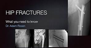 Oh-No! Broke your hip? Hip Fractures-What you need to know if you or someone you know breaks the hip