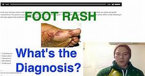 Foot rash. What's the diagnosis?