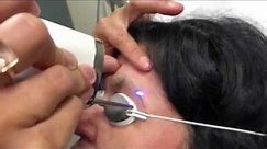 Laser Tattoo Removal on Eyebrow Performed by Dr. Manu Aggarwal
