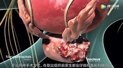 3D演示前列腺切除术，医学真是神奇！