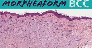 Morpheaform Basal Cell Carcinoma: 5-Minute Pathology Pearls