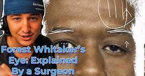 Forest Whitaker’s Eye- Explained by an Eyelid Surgeon | Understanding Ptosis