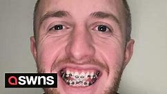 "I chose have braces in my 30s over Turkey teeth - I don't regret my decision despite trolls"