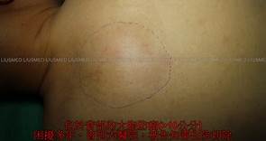 皮膚腫瘤切除手術：脂肪瘤與粉瘤的處理過程及手術簡介 - 劉達儒醫師