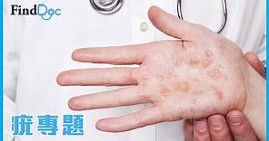 手指上出現一粒粒，是繭還是疣？－周家源皮膚及性病科專科醫生@FindDoc.com