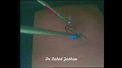 Smiley needle technique of laparoscopic knot tying