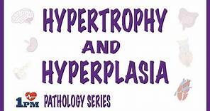 Hypertrophy and Hyperplasia