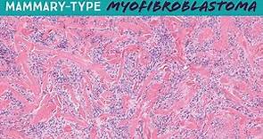 Mammary-type Myofibroblastoma - a relative of spindle cell lipoma! (Yale case 3) pathology dermpath