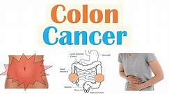 Colon Cancer (CRC) Risk Factors, Pathogenesis, Symptoms, Diagnosis, Staging, Treatment