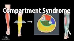 Compartment Syndrome, Animation