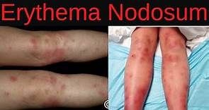 Erythema Nodosum Symptoms, Causes, Diagnosis, Treatment, Infections, Medications