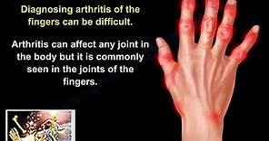 Arthritis Of The Fingers - Everything You Need To Know - Dr. Nabil Ebraheim