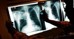 Tuberculosis: síntomas, infección, tratamiento y todo sobre la enfermedad