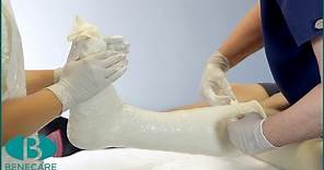 How to Apply a Below Knee Cast Using Plaster of Paris