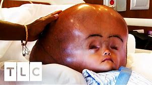 Child's Fluid-Filled Head Is 3 Times The Size It Should Be | My Baby's Head Keeps Growing