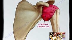 Frozen Shoulder Adhesive Capsulitis - Everything You Need To Know - Dr. Nabil Ebraheim