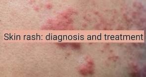 Skin Rash: diagnosis and treatment