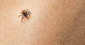 These horrifying pictures show the exact tick bite symptoms to look for