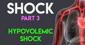 Hypovolemic Shock | Shock (Part 3)
