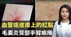 血管痣皮膚上的紅點 毛囊炎背部手臂痕癢- 最強生命線 - 香港新聞 - TVB News- 黃靖婷