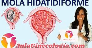 ENFERMEDAD TROFOBLÁSTICA GESTACIONAL: MOLA HIDATIDIFORME. - Ginecología y Obstetricia -