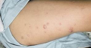 猴痘是什麼？有哪些症狀？  詳解「猴痘傳染途徑、症狀、治療&預防」-台視新聞網
