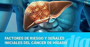 Factores de riesgo y señales iniciales del cáncer de hígado