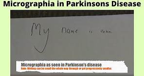 Micrographia in Parkison's disease
