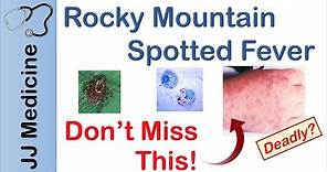 Rocky Mountain Spotted Fever | Bacteria, Signs & Symptoms, Diagnosis and Treatment
