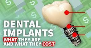 💰 Dental Implants • What They Are and How Much Implants Cost 💰