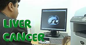What Is Liver Cancer? (Symptoms, Causes & Treatments) - Macmillan Cancer Support