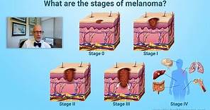 What are the stages of melanoma?