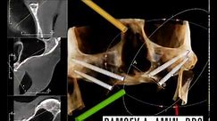 Zygomatic Implant Planning -Ramsey Amin DDS -Burbank