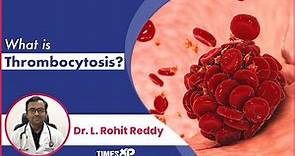 Thrombocytosis : High Platelet Count Symptoms, Conditions & Treatment Procedures | TimesXP
