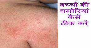How To Prevent & Treat Prickly Heat Rashes In Babies || Home Remedies