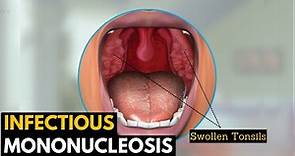 Infectious mononucleosis, Causes, Signs and Symptoms, Diagnosis and Treatment.