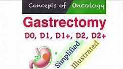 Gastrectomy- D0, D1, D1+, D2, D2+