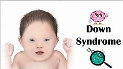 Down Syndrome - Signs & Symptoms (Clinical Features), And Long-Term Complications