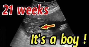 21 weeks, ultrasound showing baby boy !!